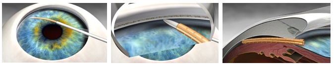 CyPass Micro-Stent CyPass Micro-Stent