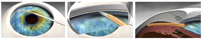 CyPass Micro-Stent 