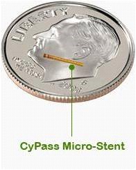 CyPass Микро-Стент CyPass Микро-Стент