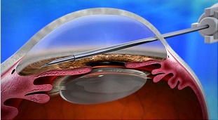 Xen Gel Stent Xen Gel Stent