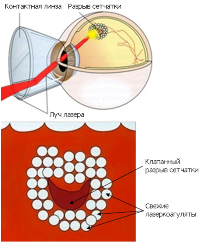 Лазерная коагуляция сетчатки