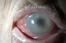 Глаз с развившейся эндотелиально-эпителиальной дистрофией роговицы. Видна отечная, тусклая роговица. Острота зрения до операции 0.07–0.09. 