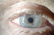 Больному выполнена сквозная субтотальная кератопластика. Трансплантат прозрачный, виден обвивной непрерывный шов. Острота зрения с коррекцией 0.8. Больному выполнена сквозная субтотальная кератопластика. Трансплантат прозрачный, виден обвивной непрерывный шов. Острота зрения с коррекцией 0.8.