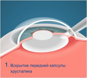 Этапы операции факоэмульсификации Этапы операции факоэмульсификации