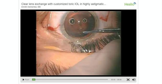 Ocular Surgery News опубликовал видео операции, проведенной Дмитрием Дементьевым