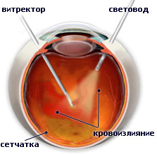 Витрэктомия